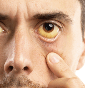 cuidados da hepatite no churrasco (1)